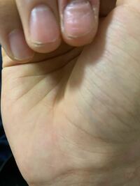 中指の爪がボコボコです。 夏休み中に治したいのですがどうすれば治りますかね？
