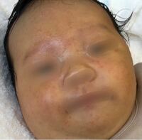 これは乳児湿疹 アトピー 生後3ヶ月の息子の肌がこんな感 Yahoo 知恵袋