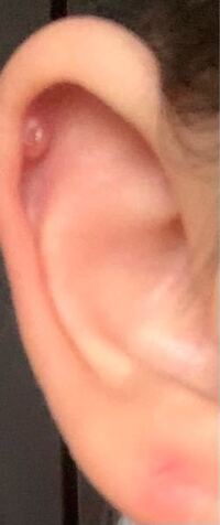 蝶のピアスの下に出来ている白いできものは 肉芽でしょうか 2日ほ Yahoo 知恵袋