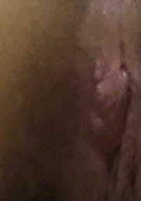 画像注意今日小陰部に出来物を発見しました 触ると痒みや痛みを伴います Yahoo 知恵袋