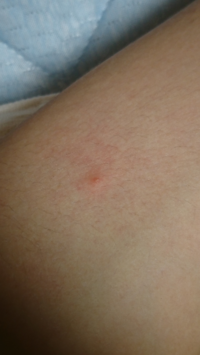 これってマダニでしょうか 画像参照 教えて 住まいの先生 Yahoo 不動産