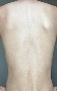 画像有背中を鏡で見たら 白い斑点のようなものができていました Yahoo 知恵袋