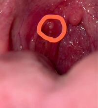 喉の奥にニキビのような白い出来物ができました 飲み込むと痛いです 昨日エ Yahoo 知恵袋