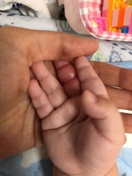 4ヶ月の赤ちゃんですが 朝見てみたら中指がパンパンに腫れています最 Yahoo 知恵袋