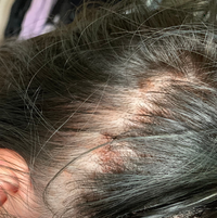 先日美容室でカラーをしたら 頭皮が荒れました 私は初めて髪を染め Yahoo 知恵袋