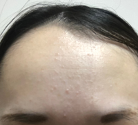 最近 おでこに写真のような赤みのあるブツブツや白いブツブツが多 Yahoo 知恵袋