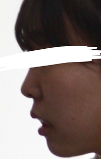 鼻を整形しようと考えています 出っ歯でもないのに唇が出ているのが気になり Yahoo 知恵袋