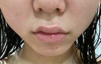 上唇にヒアルロン酸入れたら人中短く見えますかね？ 鼻も整形しようと思っています。