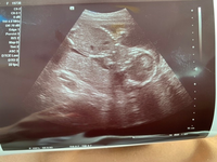 妊娠18w6dの妊婦です エコーから性別判断何となくでもできま Yahoo 知恵袋