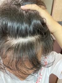 高二の男なんですけど 少し髪をあげたらこのようになってしまいます ハゲて Yahoo 知恵袋