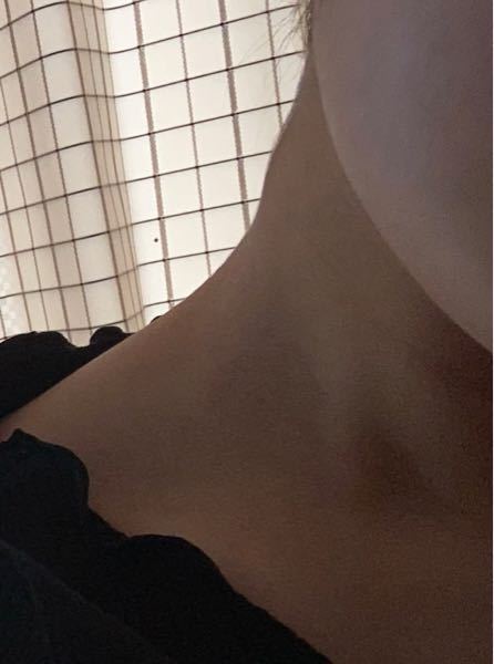 首しこり写真あり - 首の横に、丸いしこりのようなものができました 