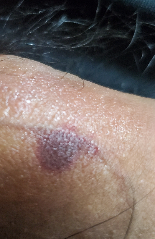 これって性病ですか 痒みも痛みも全くないのですが チャックで挟ん Yahoo 知恵袋