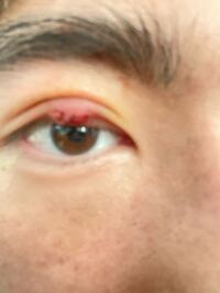 以前霰粒腫のものもらいになり 切開してもらい眼帯を1日つけて今 Yahoo 知恵袋