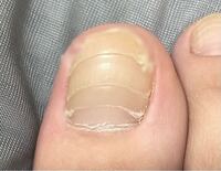 足の親指の爪が横に割れている のですが これは病気でしょう Yahoo 知恵袋