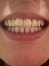 歯並びについて悩みがあります 前歯の1本が出ていて 見た目的に Yahoo 知恵袋