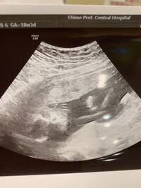 現在妊娠5ヶ月の者です 本日病院で診察してもらいこちらのエコー写真 Yahoo 知恵袋