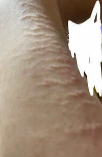 肌 太もも に変なのができて困ってます これなんですか あと出 Yahoo 知恵袋