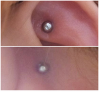 先月29日に初めてニードルでアウターコンクを開けました 一昨日 Yahoo 知恵袋