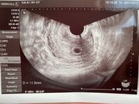エコー写真について教えて欲しいです 現在5w1dです 病院 Yahoo 知恵袋