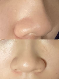 鼻整形についてこの鼻をきれいにするにはどんな整形が必要ですか Yahoo 知恵袋