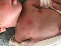 新生児発疹生後22日です お腹にぷつっと出来たなー と思ってた Yahoo 知恵袋