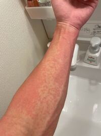 寒い時期の風呂上がりなどに発症します 調べてみたらコリン性蕁麻疹 だと思 Yahoo 知恵袋