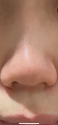 自分はこのように鼻柱が引っこんでいます 綺麗な鼻にするには何の整形がおす Yahoo 知恵袋