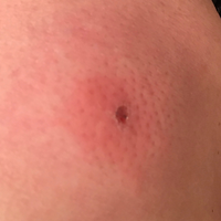 虫刺されについて 直径約25mmの巨大な虫に刺された 咬まれた 跡があ Yahoo 知恵袋