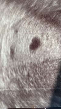 5w4dのエコー写真です 胎嚢8 8mmです この大きさは平均 Yahoo 知恵袋