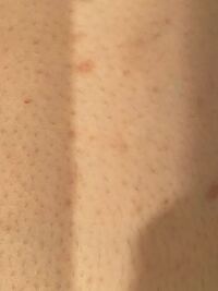 観覧注意です 少し前から皮膚に写真のようなぶつぶつ ができてます Yahoo 知恵袋