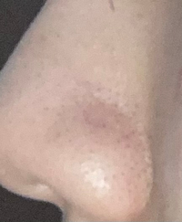 ⚠︎閲覧注意です。
 私の鼻がいちごすぎてやばいです。
 これは横から撮った写真なんですが、この画質の悪さでもわかる黒のぶつぶつ…
 角栓とかもあります。。
 どうにか治らないでしょうか？ 
