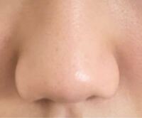 鼻の整形を考えています。(小鼻縮小、鼻尖縮小) 私の鼻は、だんご鼻で小鼻が張っている思うのですが、マシにするには小鼻縮小と鼻尖縮小どちらの方か、両方かどの施術が良いでしょうか？
