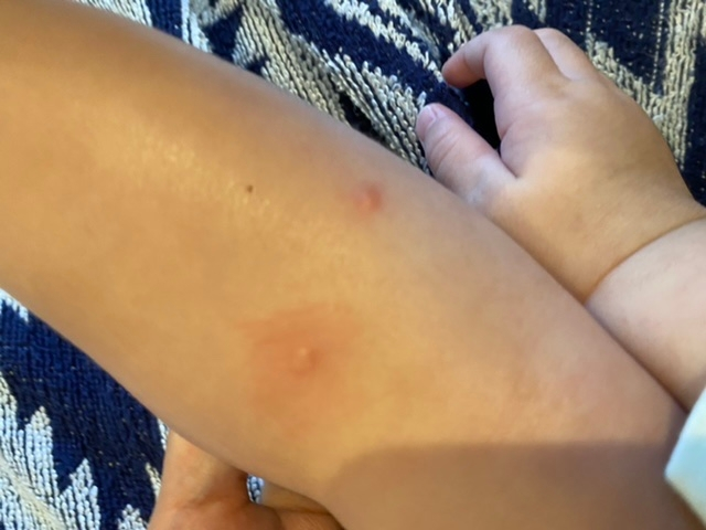 子供の足にできてしまったのですが水イボのような水疱瘡のような 