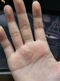 手の皮膚が剥けます 今までない症状です 怖いです お風呂入った後が Yahoo 知恵袋