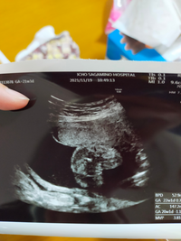 妊娠6ヶ月の検診で ほぼ女の子と言われたのですが これは本当に Yahoo 知恵袋