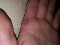 野球のバットで素振りしていて水ぶくれが手にできたんですけど水 Yahoo 知恵袋