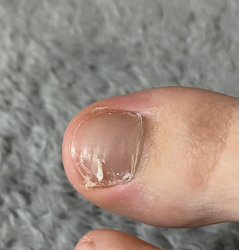 足の爪が中間からめくれてきます。 剥がしても痛くは無いですが、爪がガタガタになり不安です。 これは水虫の症状でしょうか？？