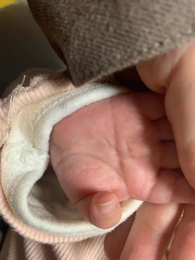 赤ちゃんのますかけ線について生後2カ月半の赤ちゃんです 右手の Yahoo 知恵袋