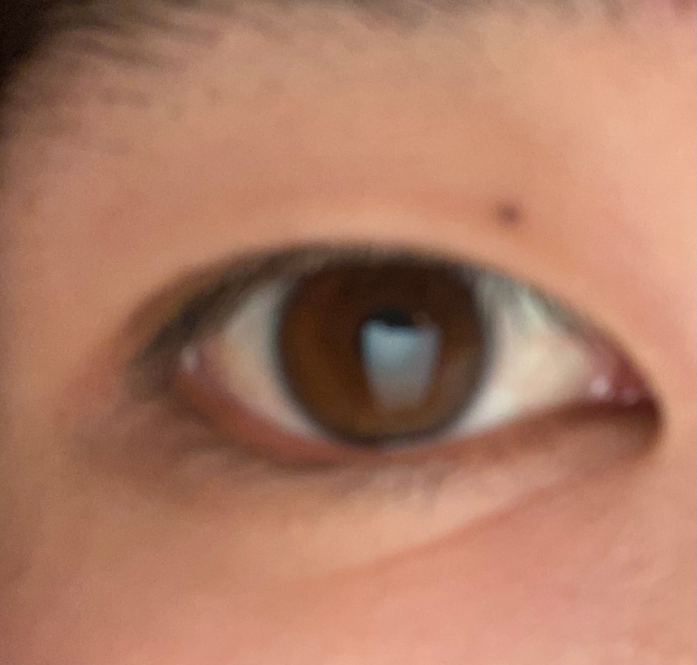 蒙古襞があって僕の場合一重なのですがこれは整形しないで治せます Yahoo 知恵袋