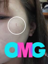 今朝ヘアアイロンで火傷しました 皮がめくれてヒリヒリします キズパワーパ Yahoo 知恵袋