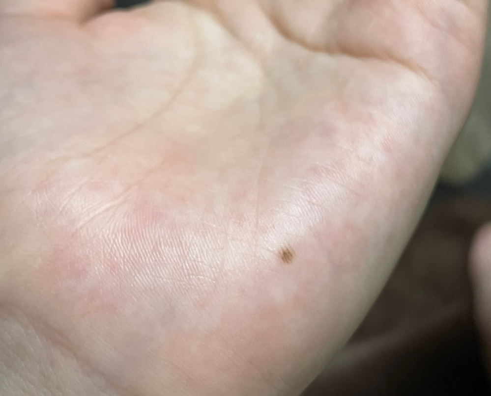 ホクロについてです。 - 今まで無かったのに、今気づいたら新しく手のひ... - Yahoo!知恵袋