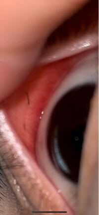 埋没したんですけど内側から糸がこんな感じで見えています 目がゴロゴロして Yahoo 知恵袋