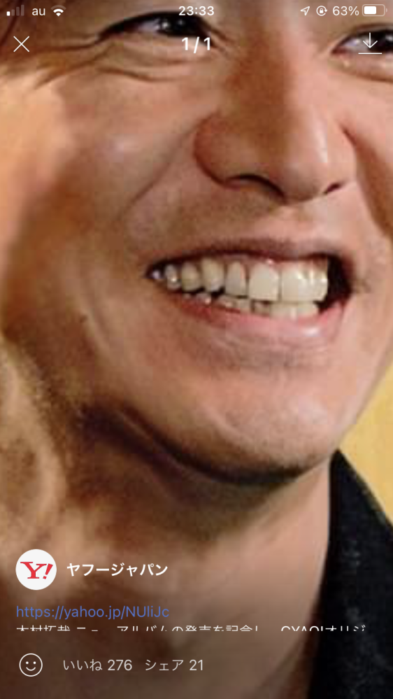 キムタクは入れ歯ですか？ 今LINEのvoomにキムタクの写真が出てました。右上の奥歯ですが、金具が見えてます。
