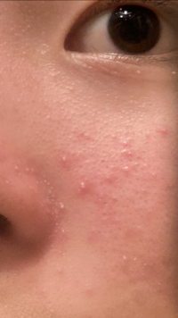 汚い肌通ります 鼻の横にあるブツブツはなんですか あと私の肌を見て Yahoo 知恵袋