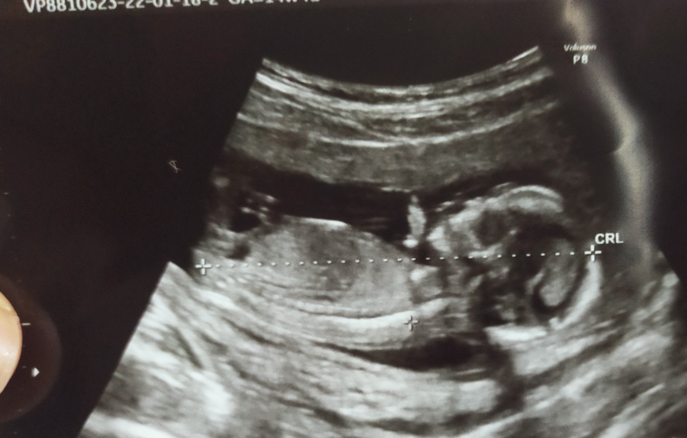 妊娠14週5日目です。 先日の検診で初めて超音波検査をしてきました。 この超音波検査は胎児異常の発見をするものではなく、異常妊娠がないか、大きさはどれ位か、等を見る為の超音波検査です。 医師には...