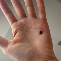 高校2年生です 血豆ができました 弓道部です 弓を引くた Yahoo 知恵袋