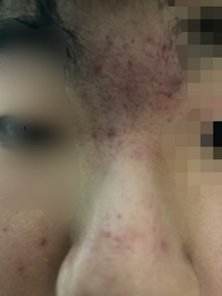 高校生男子です ニキビ跡の治し方を教えてください 親には美容皮膚科はダメ Yahoo 知恵袋