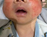 これはアトピーですか 乳児湿疹ですか 皮膚科か小児科に行った方がい Yahoo 知恵袋