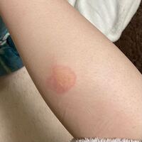 今朝 湯たんぽで低温やけどしてしまいました 自力で治す方法教えてく Yahoo 知恵袋