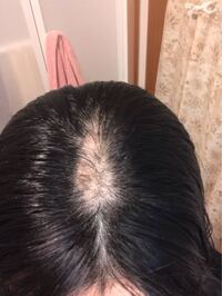 髪の毛を抜く癖が出来てしまい 禿げてしまいました 懲りたのでもう抜 Yahoo 知恵袋